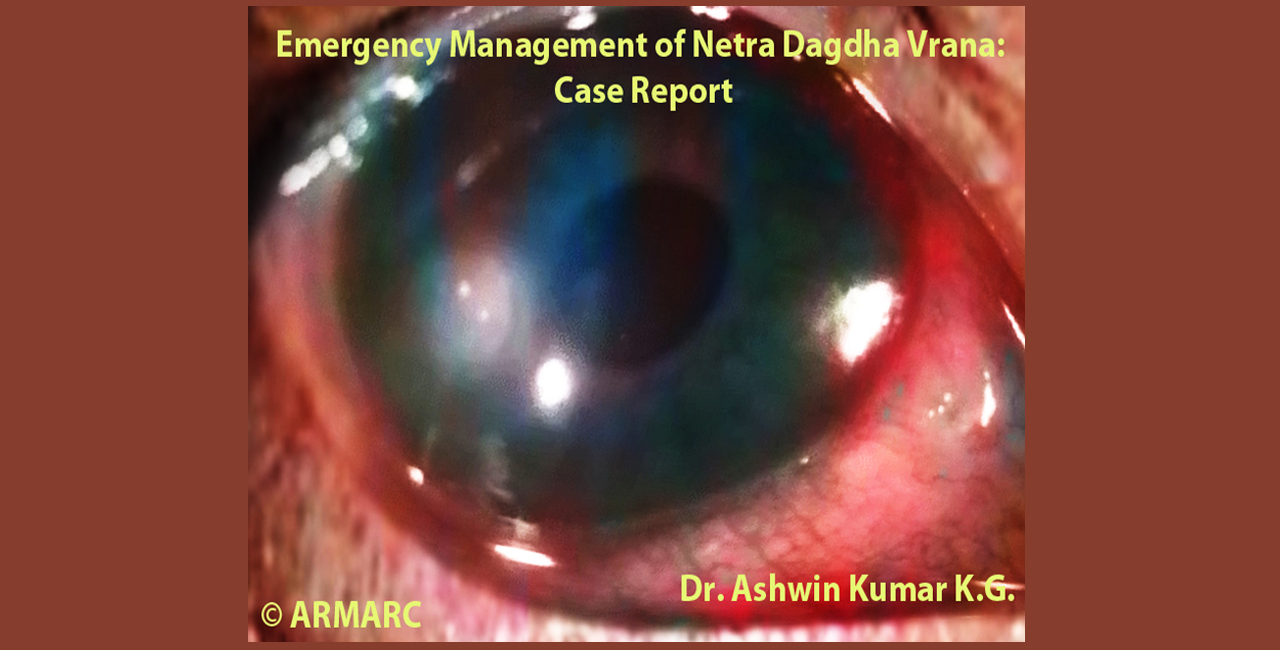 Emergency Management of Netra Dagdha Vrana: Case Report