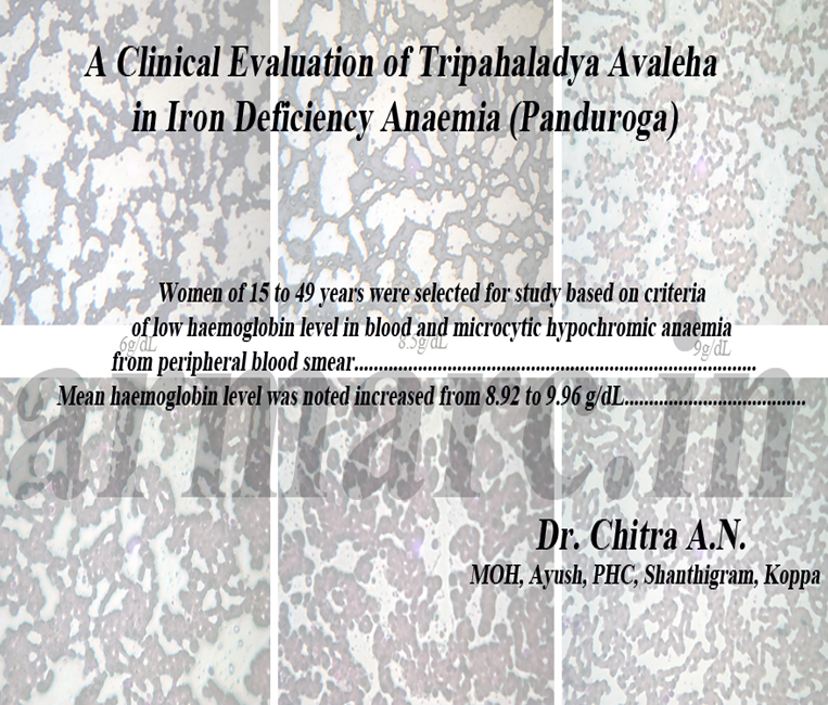 A Clinical Evaluation of Tripahaladya Avaleha in Iron Deficiency Anaemia (Panduroga)